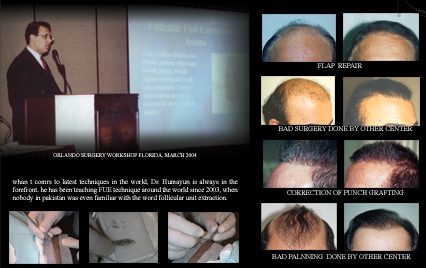 Follicular Unit Extraction (FUE) Hair Transplant